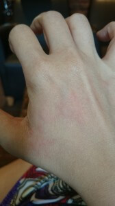 A picture of hives on my right hand from 20 June, 9:42a.m.