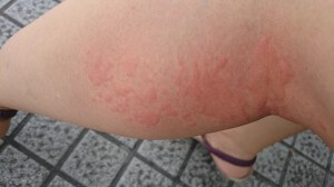 Rare: Hives outbreak on the back of my left thigh in the afternoon. 24 July at 4p.m.